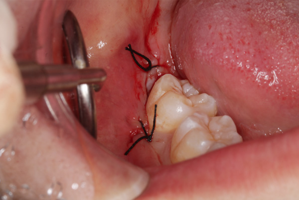 親知らず抜歯症例